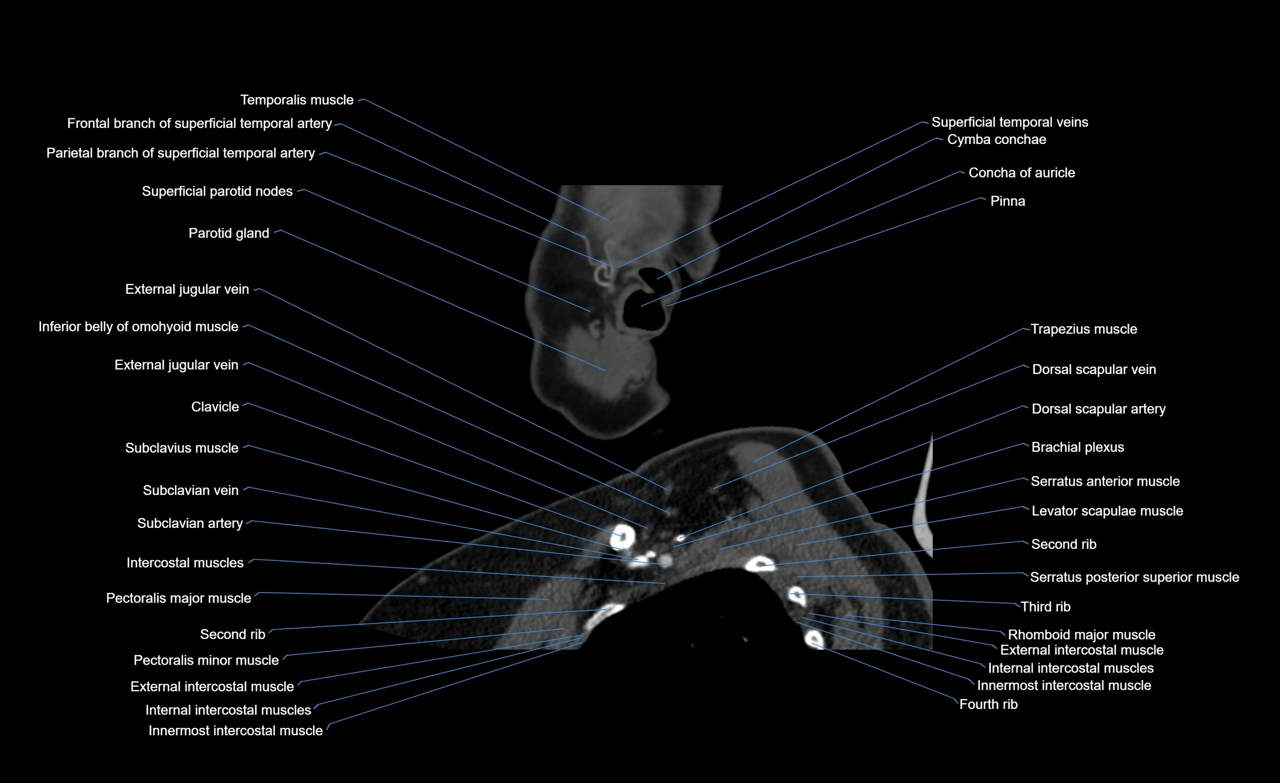 Neck CT sagittal cross sectional anatomy 3D  radiology  image-img-00001-00025.webp